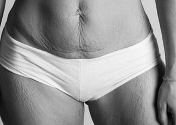 Төрсний дараах унжсан гэдсийг арилгах ШИЛДЭГ АРГУУД